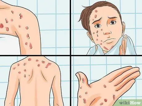 Txheeb xyuas HIV Rash Step 2