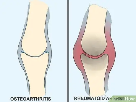 Nhận biết các triệu chứng viêm khớp Bước 11