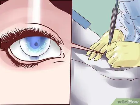 Lower Eye Pressure Without Drops Step 9