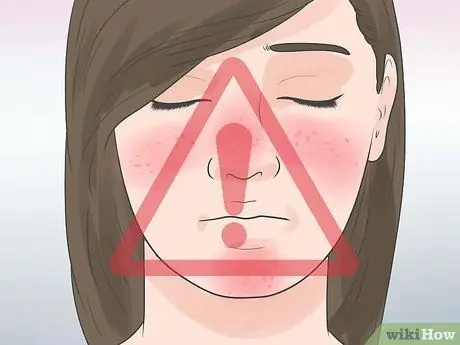 Recognize an Eyelid Cyst Step 10