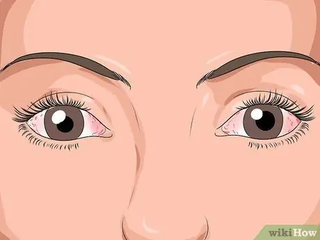 Singkirkan Pink Eye Fast Step 1