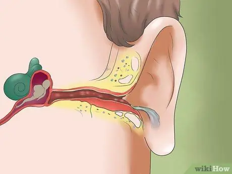 Guérir une infection de l'oreille Étape 2