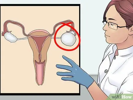 Know if You Have an Ovarian Cyst Step 10