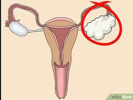 Know if You Have an Ovarian Cyst Step 11