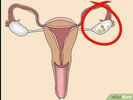 Know if You Have an Ovarian Cyst Step 12