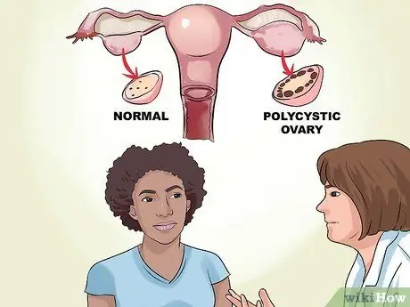 Herken de symptomen van polycysteus ovariumsyndroom Stap 5