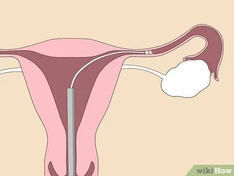 Unblock Fallopian Tubes Naturally Step 2