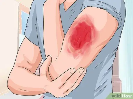 Take the Sting out of a Burn Step 5