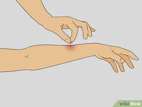 Treat a Bee Sting Step 1