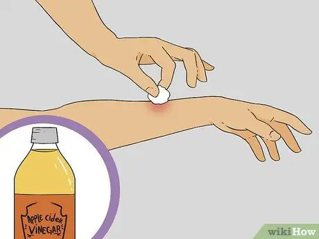 Treat a Bee Sting Step 10