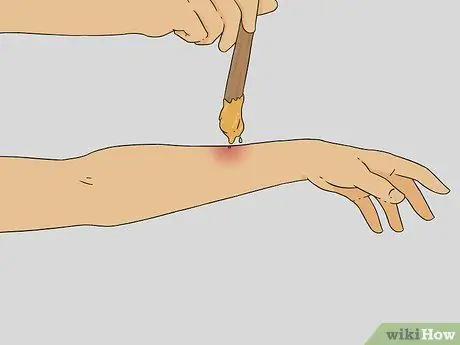 Treat a Bee Sting Step 8