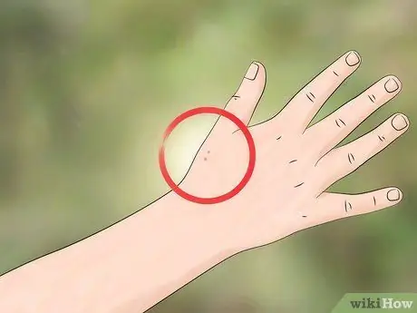 Identify and Treat Black Widow Spider Bites Step 1