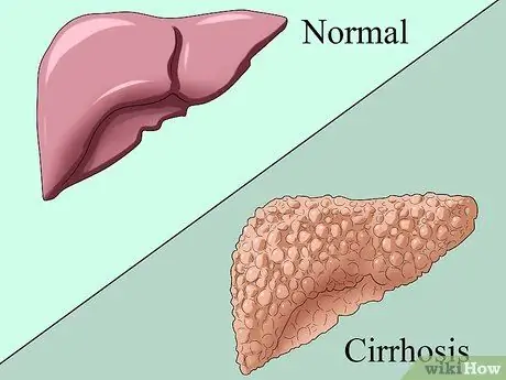 Zdravljenje hepatitisa B 3. korak