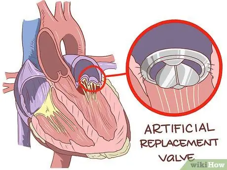 Treat an Enlarged Heart Step 11