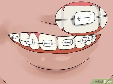 Nyeupe Meno yako wakati Una Braces Hatua ya 10