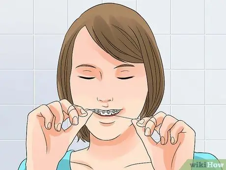 Whiten Your Teeth when You Have Braces Step 3