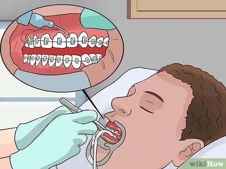 Nyeupe meno yako wakati una braces Hatua ya 8