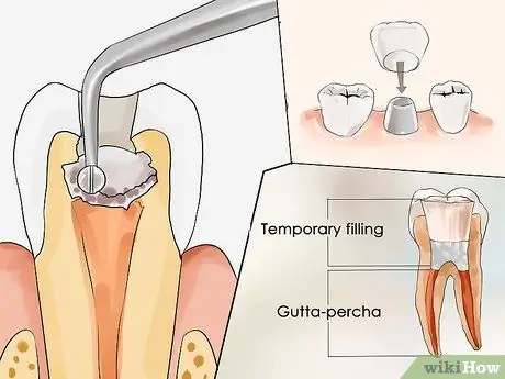 Behandle en tannabscess Trinn 6