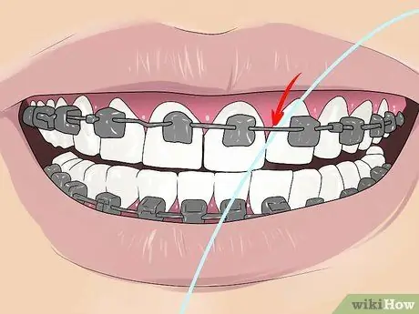 Floss with Braces ደረጃ 2