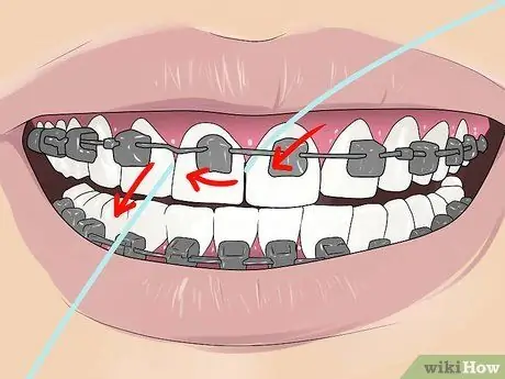 Floss with Braces ደረጃ 3