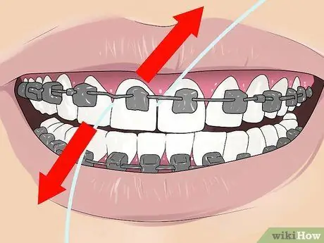 Floss with Braces ደረጃ 4