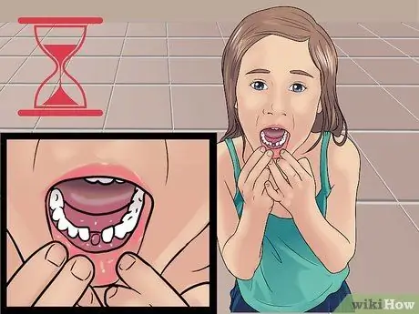 Stop the Bleeding After You Pull out a Loose Tooth Step 1