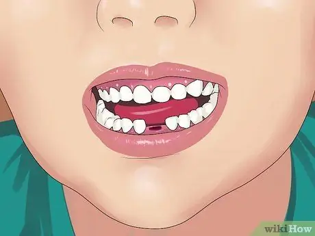 Stop the Bleeding After You Pull out a Loose Tooth Step 2