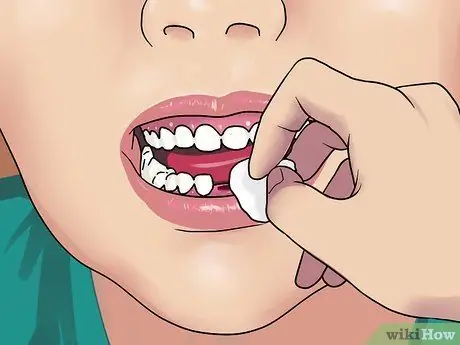 Stop the Bleeding After You Pull out a Loose Tooth Step 3