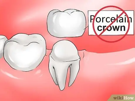 Evita i problemi della corona dentale Passaggio 4