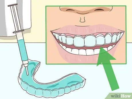 Cope with Teeth Whitening Sensitivity Step 3