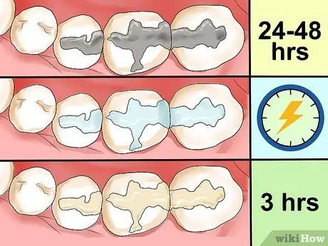 Cuidados com o preenchimento de um dente, passo 1