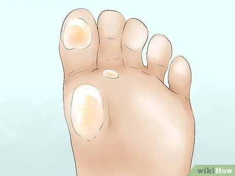 Cure Athlete's Foot Naturally Step 2