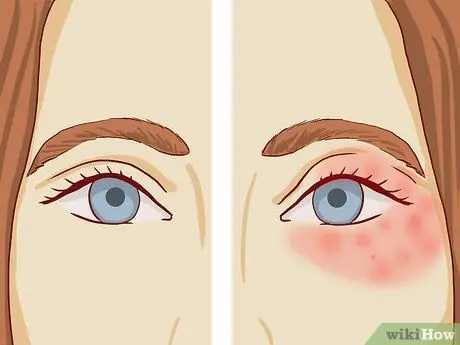 Trate o eczema ao redor dos olhos, etapa 3