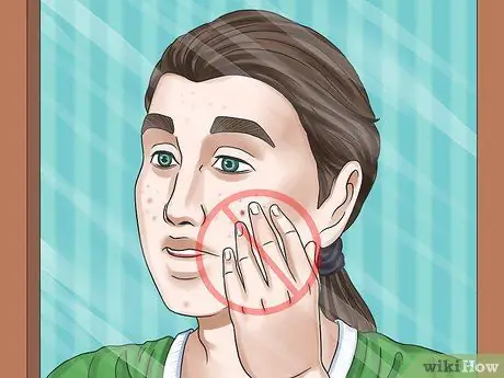 Get Rid of a Zit Overnight Step 13