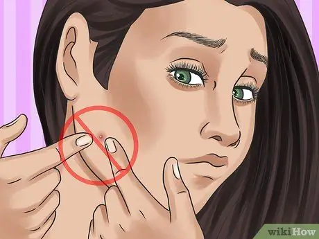 Get Rid of a Zit Overnight Step 16