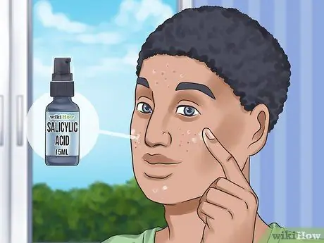 Get Rid of a Zit Overnight Step 2