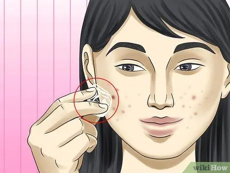 Get Rid of a Zit Overnight Step 9