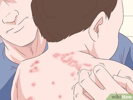 Điều trị Eczema Tay Bước 4