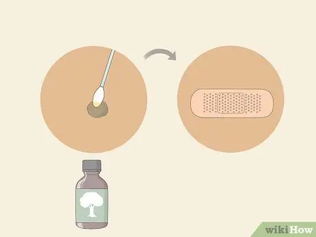 Get Rid of Warts Step 15