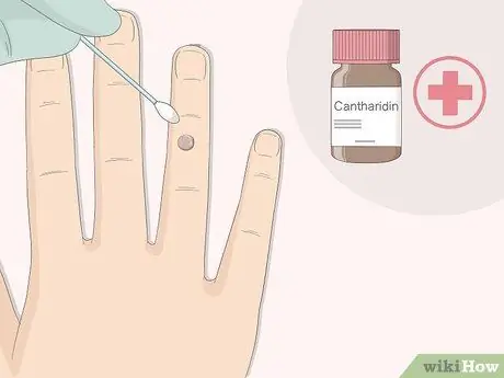 Get Rid of Warts Step 4