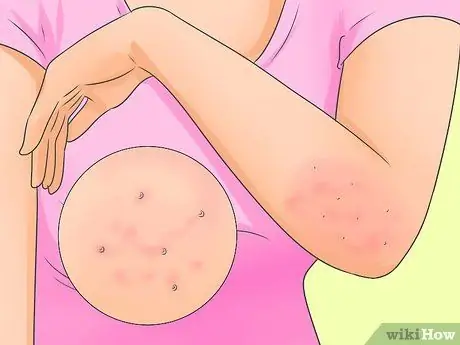 Cure Scabies Pasul 1