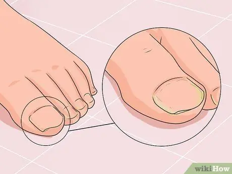 Cure Nail Fungus Step 1