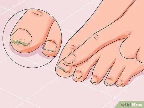 Cure Nail Fungus Step 3