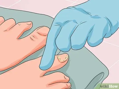 Cure Nail Fungus Step 4