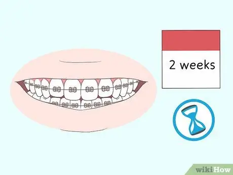 Kiss With Braces Langkah 1