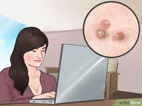 Know If You Have Herpes Step 8