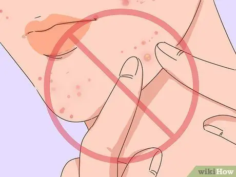 Get Rid of Acne Fast Step 15