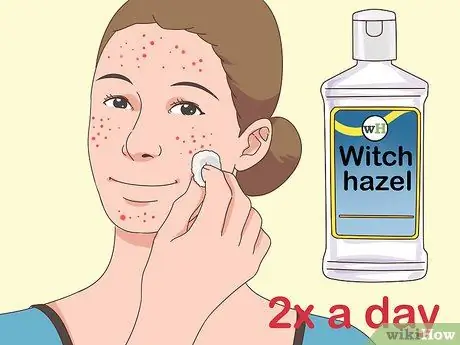 Tanggalin ang Mabilis na Acne Hakbang 7