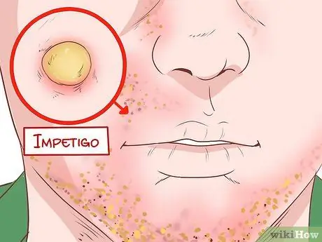 Идентифицирайте симптомите на MRSA Стъпка 9